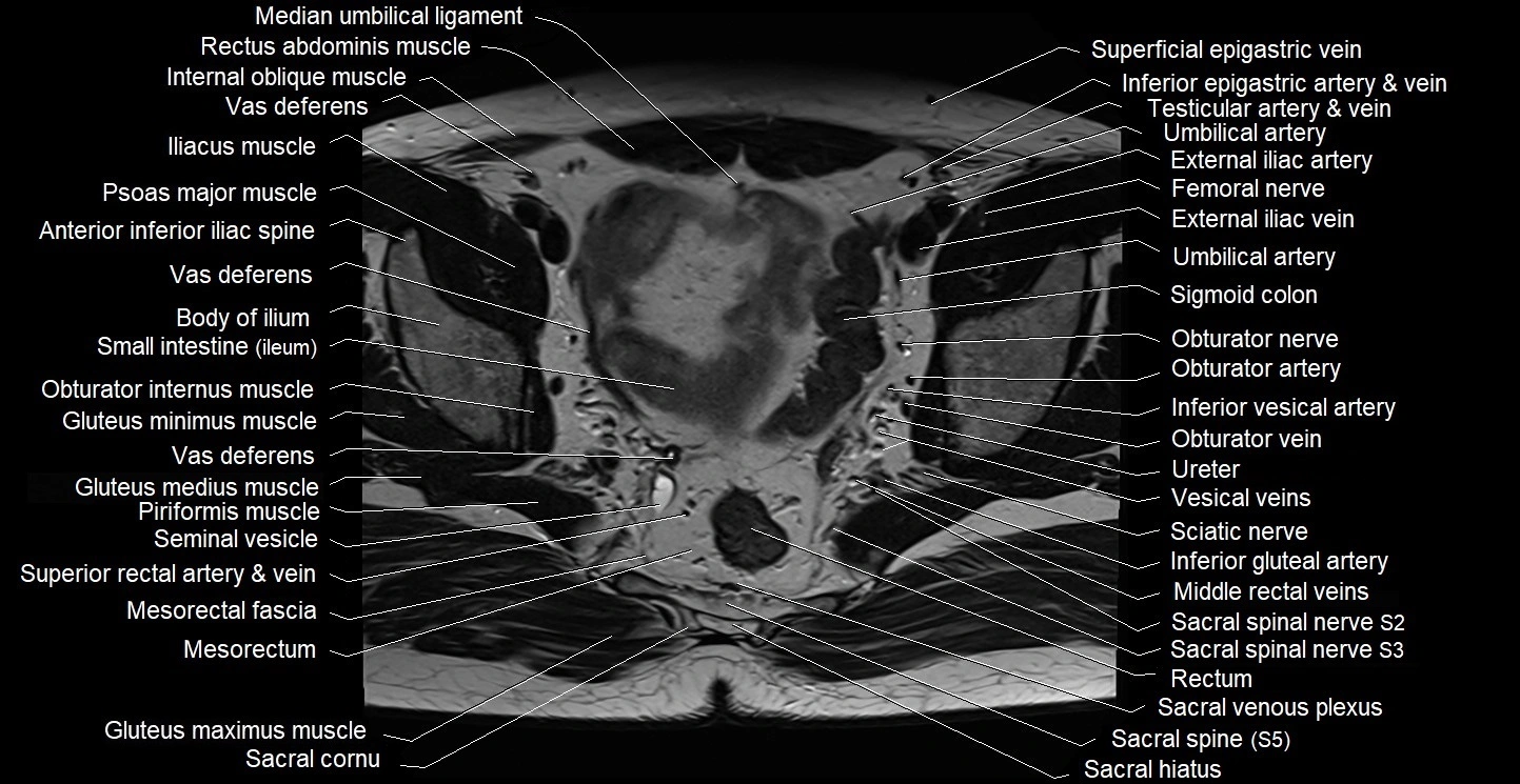 Male pelvis axial cross sectional anatomy image 19.webp